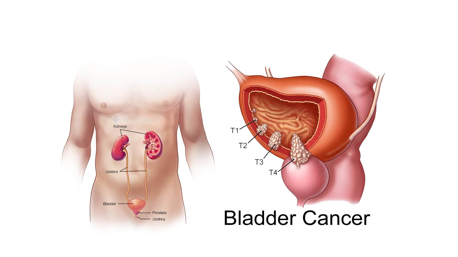 Bladder Cancer Icd 10