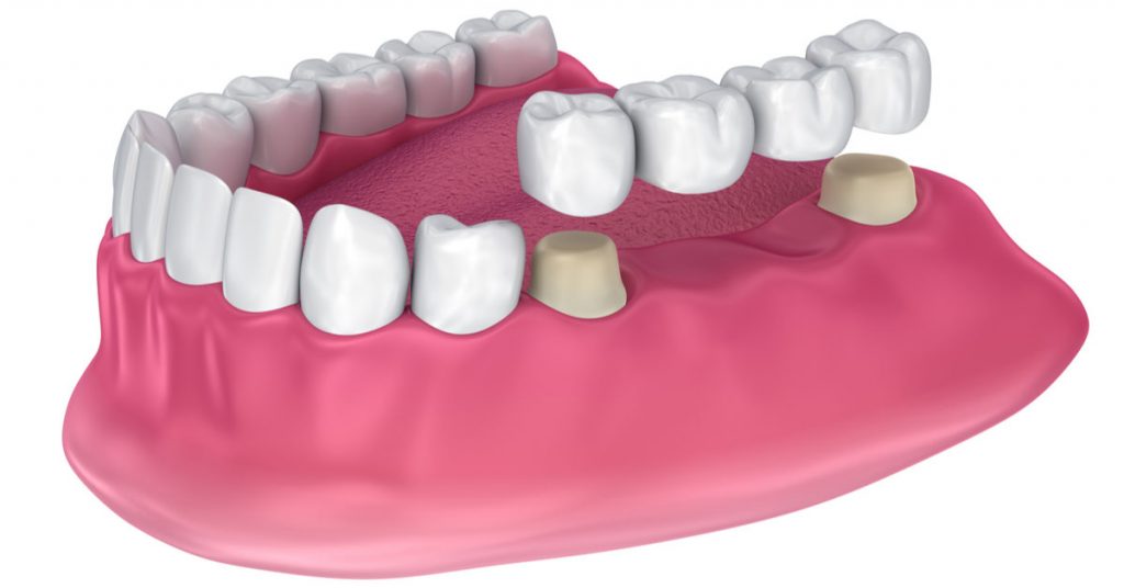 All-you-need-to-know-about-dental-bridges