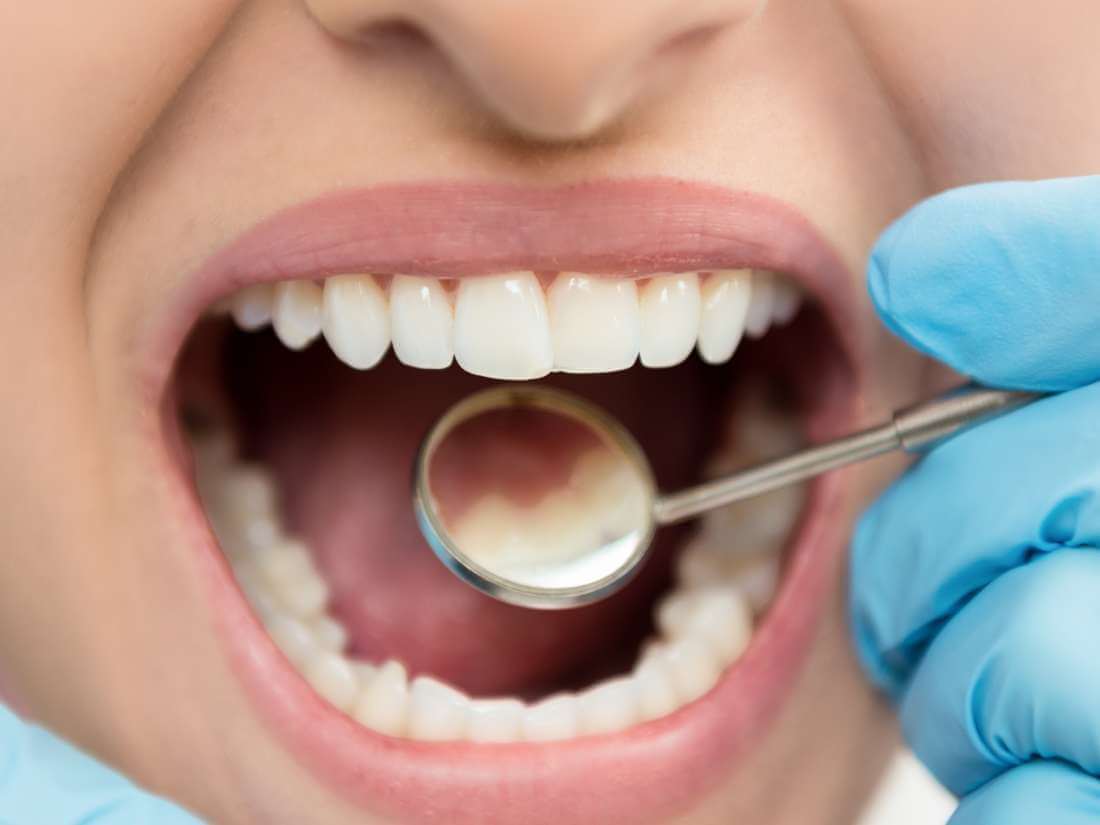 What Is a Dead Tooth and How to Prevent It?