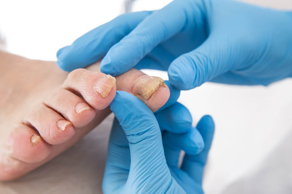 How do medical professionals diagnose fungal nails