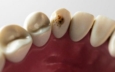 What Does a Cavity Look like and Its Signs or Symptoms?