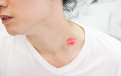 Top Easy Ways of How to Get Rid of Hickeys