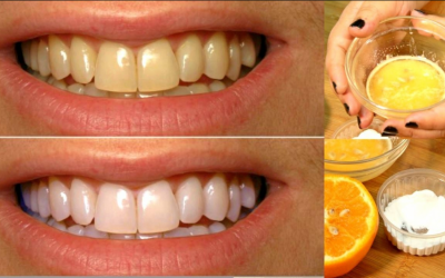 8 Easy Ways for How to Get Rid of Yellow Teeth