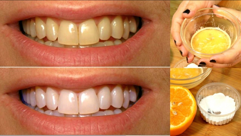 8 Easy Ways for How to Get Rid of Yellow Teeth