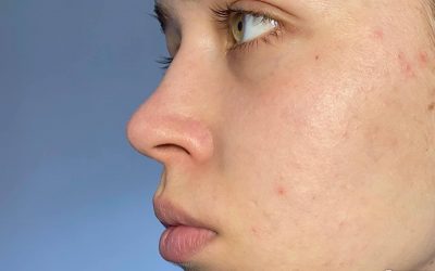 What Is Fungal Acne – How to Treat and Prevent It?
