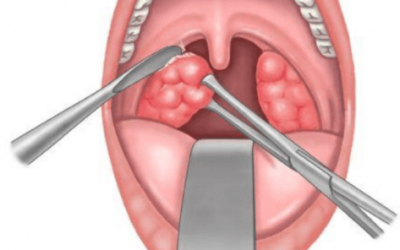 Tonsillectomy Scabs – All You Need to Know