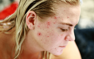 How Women Can Prevent Adult Acne