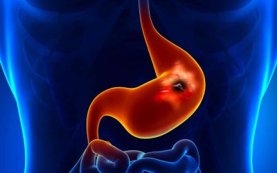 Delayed Gastric Emptying Causes, Symptoms, and Treatment