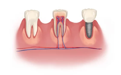 Root Canal on Front Tooth: What to Expect?