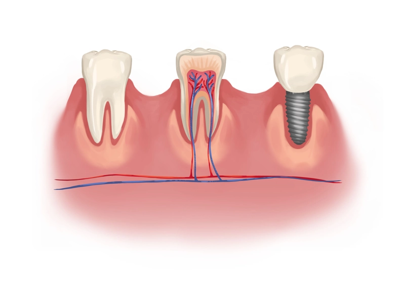 Root Canal on Front Tooth: What to Expect?