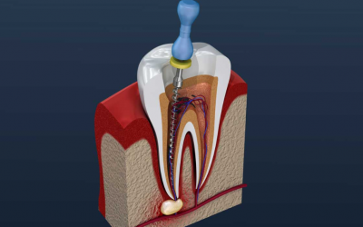 A Guide to Root Canal Therapy