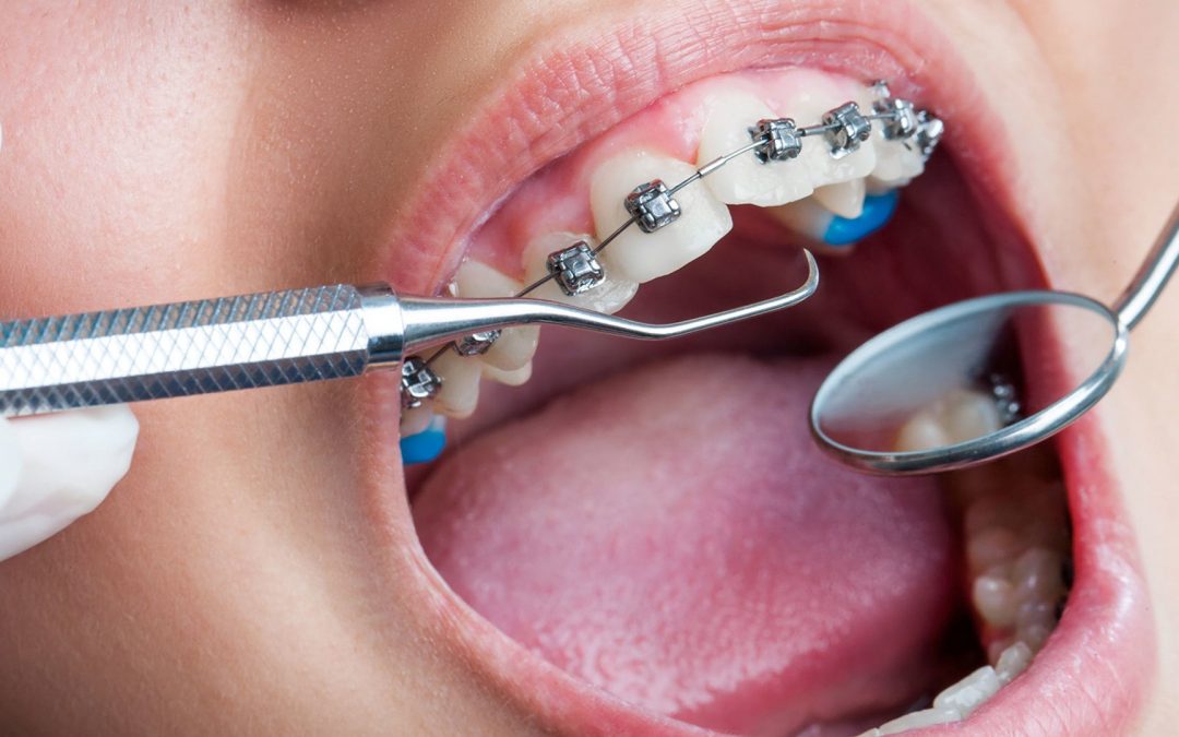 Find out Are Your Braces Covered by Insurance?