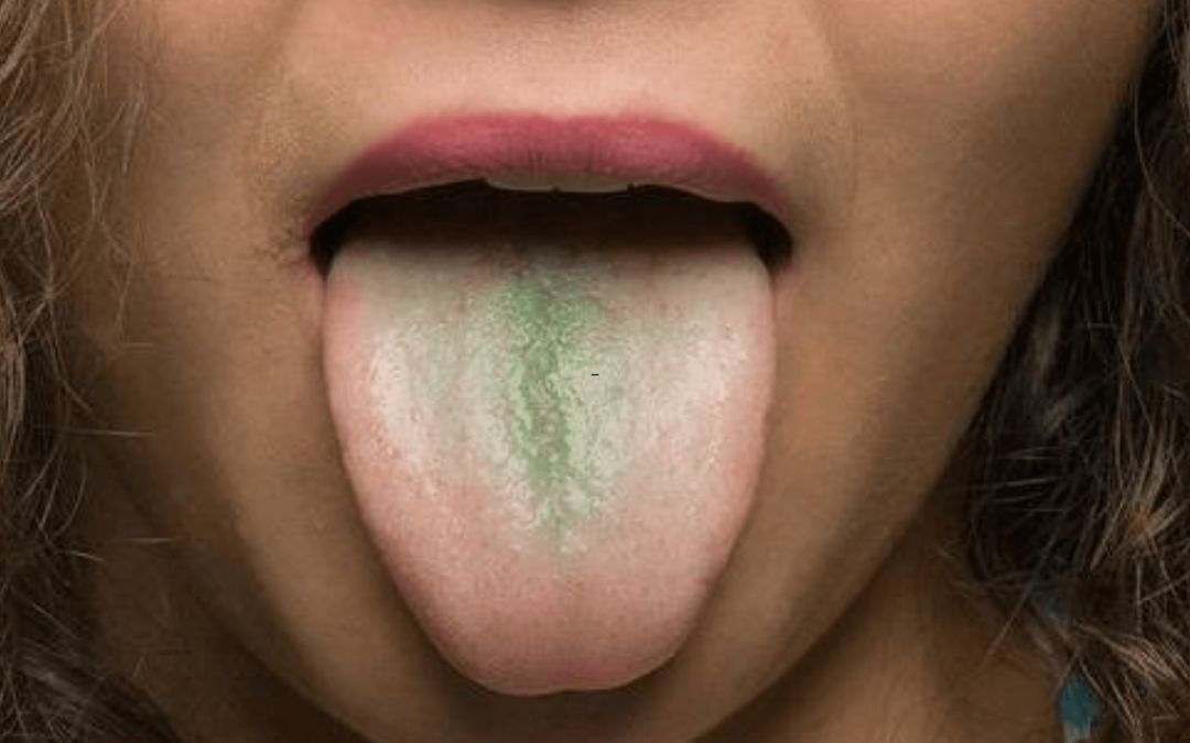 Green Tongue: 7 Reasons, Diagnosis, and Treatment 