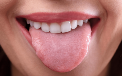 Understanding Scalloped Tongue: Causes and Treatment