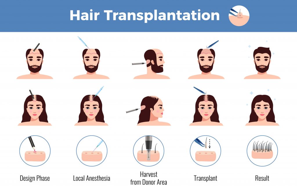 steps in hair transplantation