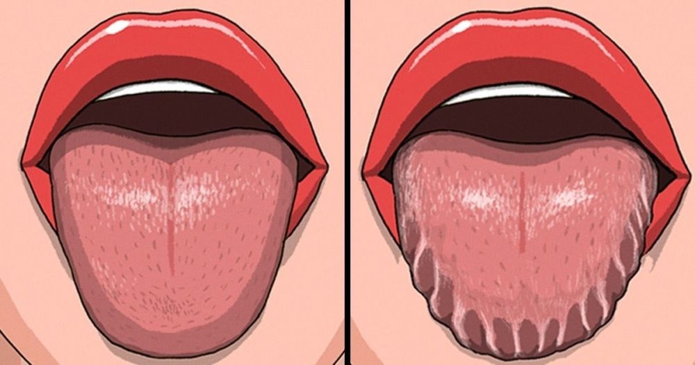 understanding scalloped tongue