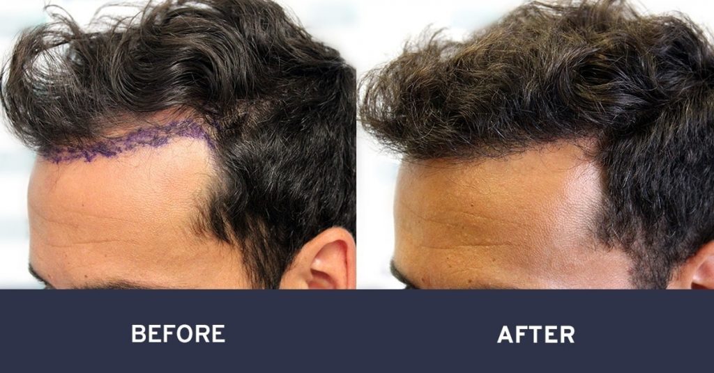 forehead reduction surgery before and after