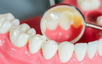 What Does Having White Gums Indicate?