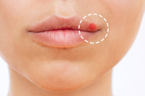 Pimples on upper Lip Disappear, Causes & Prevention (2023)